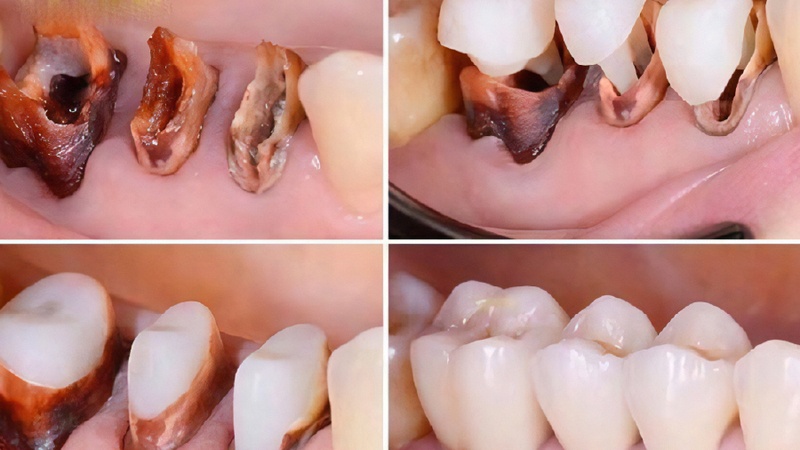Tạo cùi giả khi thân răng quá yếu