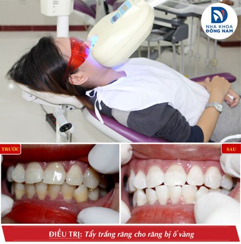 Tẩy trắng răng tại nha khoa đem lại hiệu quả nhanh chóng