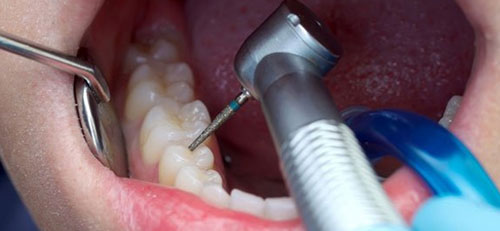 Trám răng không gây ảnh hưởng gì nếu thực hiện đúng kỹ thuật
