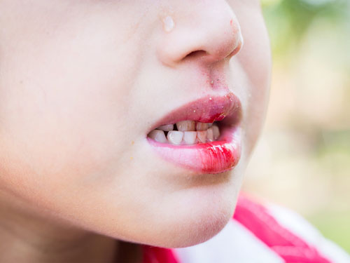 Trẻ bị chấn thương răng thường đi kèm với chảy máu, rách môi nướu