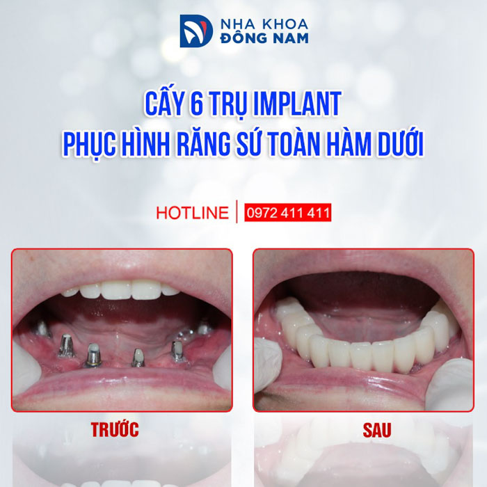 Trồng răng Implant toàn hàm dưới cho bệnh nhân mất răng lâu năm
