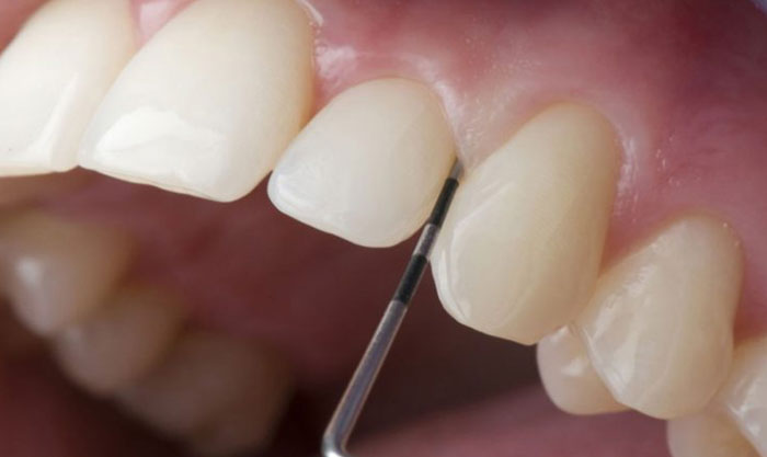 Tỷ lệ mài răng được bác sĩ tính toán cẩn thận và chính xác