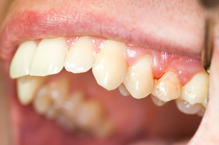Vệ sinh răng miệng kém làm tăng nguy cơ mắc bệnh viêm nướu, viêm nha chu