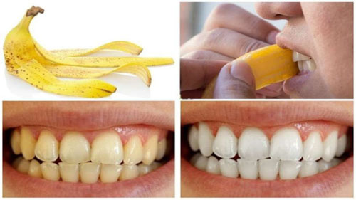 Vỏ chuối cũng có thể dùng để làm trắng răng