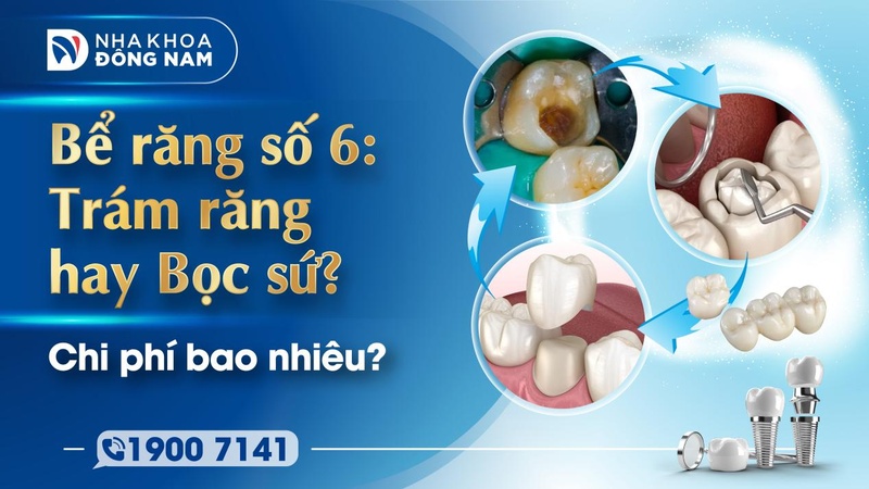 Bể răng số 6 trám hay bọc sứ