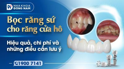 Bọc răng sứ cho răng cửa hô