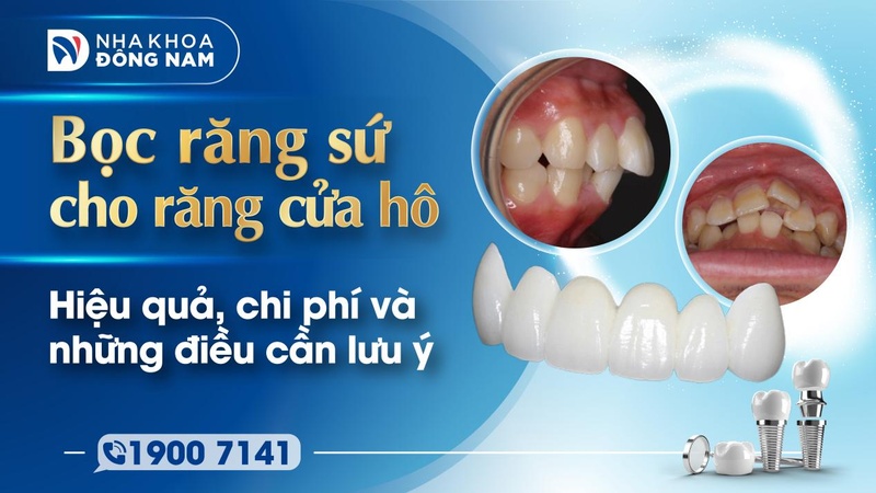 Bọc răng sứ cho răng cửa hô