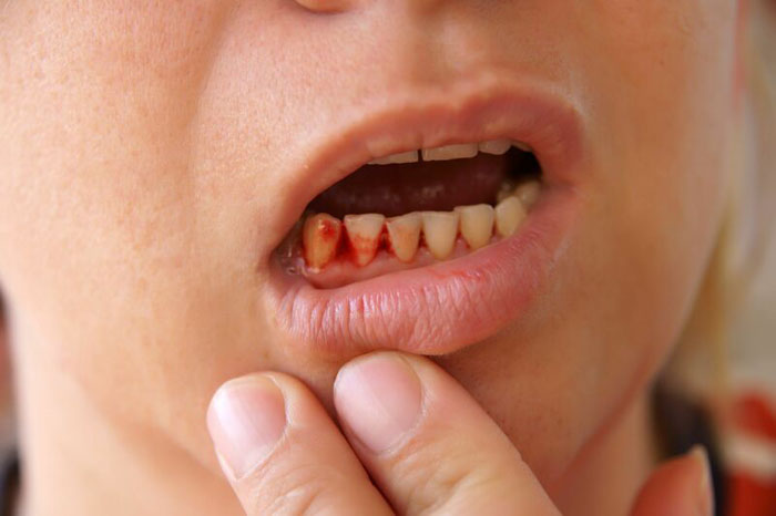Chảy máu chân răng có thể là triệu chứng của nhiều bệnh lý nguy hiểm