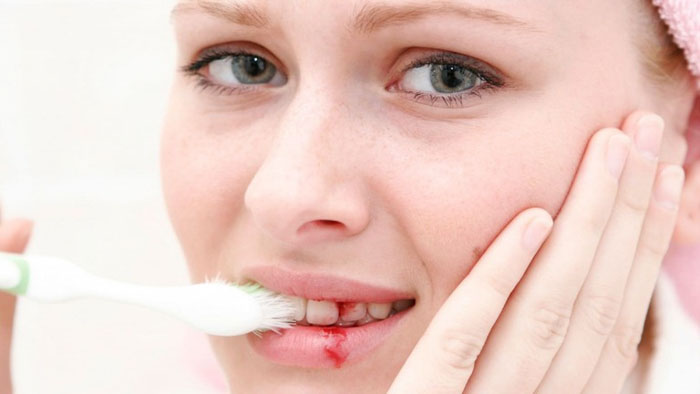 Đánh răng sai cách có thể gây chảy máu, sưng đau nướu