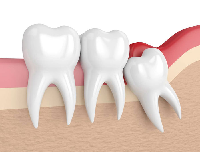 Lợi sưng viêm tấy đỏ là dấu hiệu nhận biết răng khôn mọc lệch
