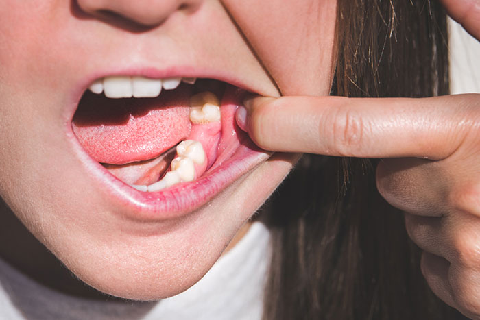 Mất răng là một trong những nguyên nhân dẫn đến hiện tượng nhai 1 bên