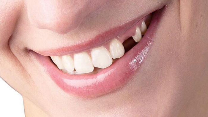 Mất răng nanh làm ảnh hưởng đến thẩm mỹ nụ cười