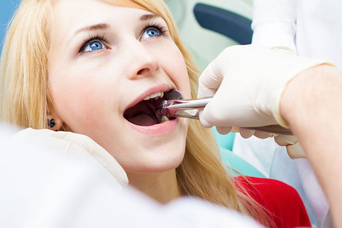 Nhổ răng khôn mọc lệch để ngăn ngừa biến chứng nguy hiểm