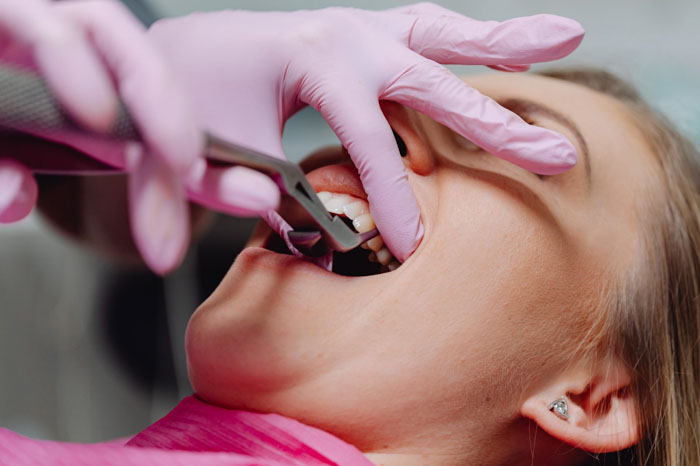 Nhổ răng nanh là thủ thuật tương đối phổ biến trong nha khoa