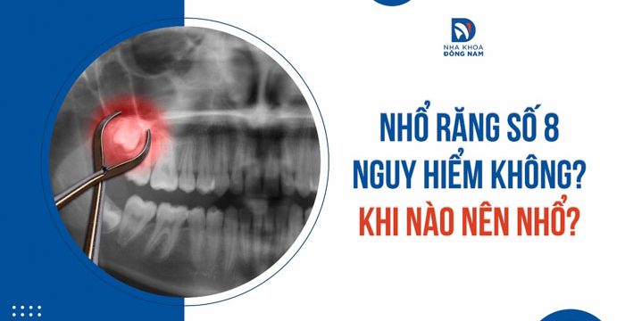 Nhổ răng số 8 nguy hiểm không? Khi nào thì nên nhổ?