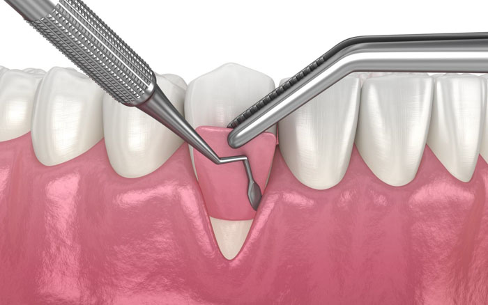 Phẫu thuật ghép nướu trong trường hợp răng nhạy cảm do tụt lợi