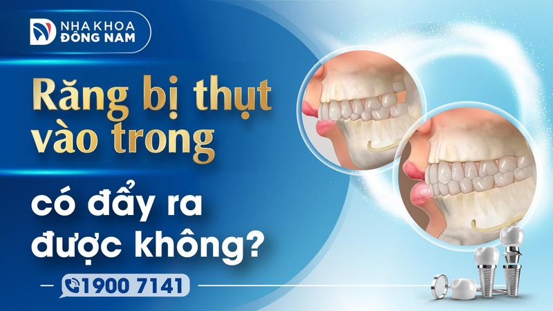 Răng bị thụt vào trong có đẩy ra được không