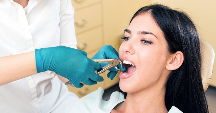 Răng đã chữa tủy nếu bị áp xe, viêm nhiễm sẽ được chỉ định nhổ bỏ