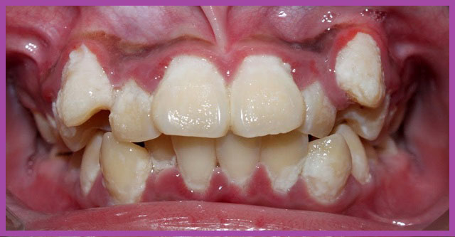 Răng khểnh dễ nhồi nhét thức ăn dẫn đến nguy cơ hình thành bệnh lý