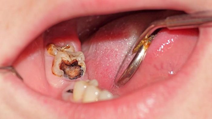 Răng khôn có bệnh lý ảnh dễ lây lan sang các răng kế bên