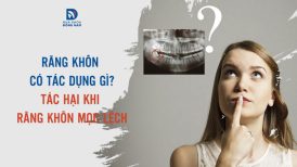 Răng khôn có tác dụng gì? Tác hại khi răng khôn mọc lệch