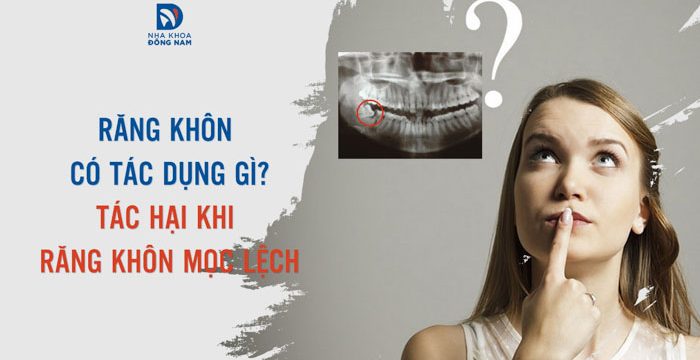 Răng khôn có tác dụng gì? Tác hại khi răng khôn mọc lệch