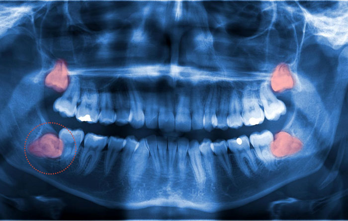 Răng khôn mọc lệch gần là hiện tượng phổ biến nhất