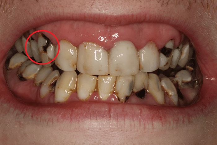 Răng nanh bị sâu nặng cần nhổ bỏ để tránh lây sang các răng bên cạnh