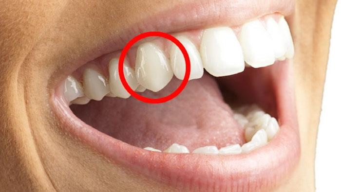 Răng nanh là chiếc răng nằm ở vị trí thứ 3 tính từ răng cửa giữa vào trong