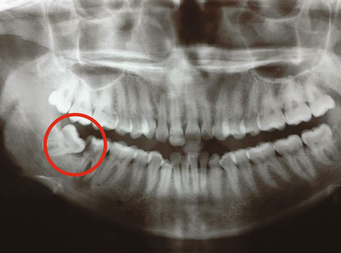 Răng số 8 là chiếc răng mọc cuối cùng trên cung hàm khi bước vào tuổi trưởng thành