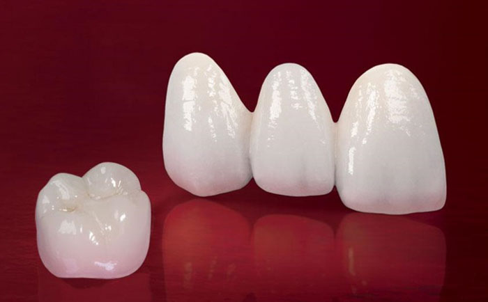 Răng sứ Cercon có cấu tạo khung sườn từ phôi sứ chất lượng cao
