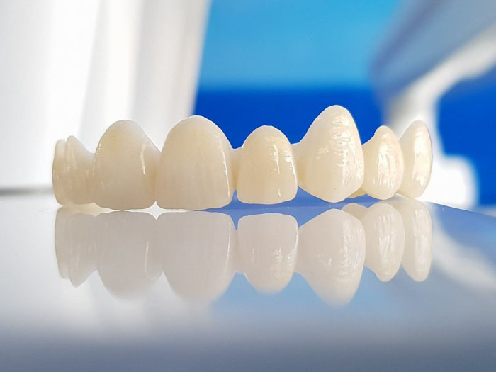 Răng sứ Emax được đánh giá cao về mặt thẩm mỹ