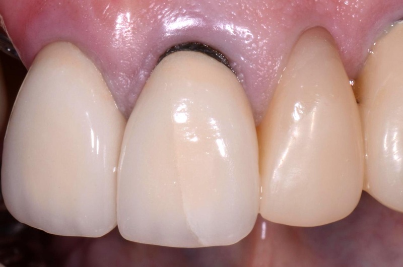 Răng sứ kim loại có độ bền chắc tốt giúp ăn nhai thoải mái