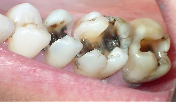 Sâu răng, viêm tủy sẽ gây đau nhức, ê buốt ở răng