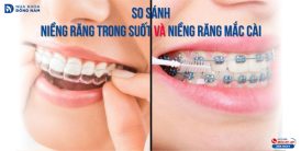 So sánh niềng răng trong suốt và niềng răng mắc cài