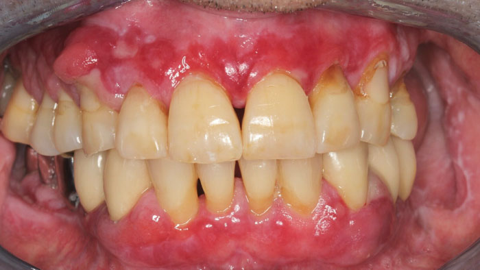 Sưng nướu răng là tình trạng khá phổ biến hiện nay