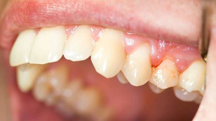 Viêm nướu là một trong những nguyên nhân làm chảy máu chân răng