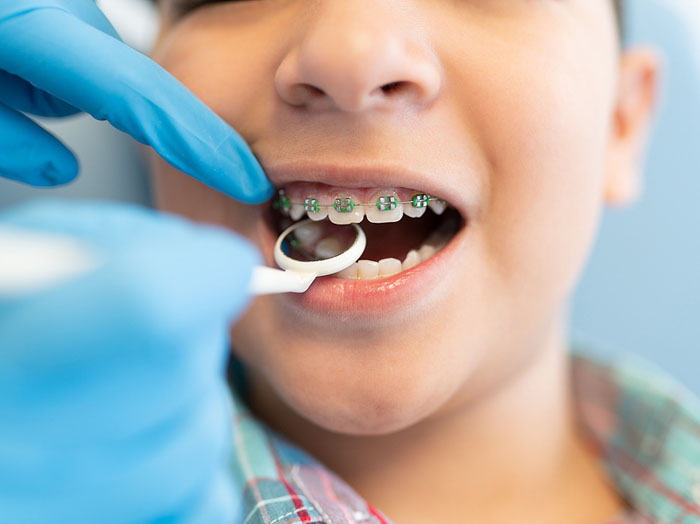 12 – 16 tuổi được xem là thời điểm vàng để niềng răng