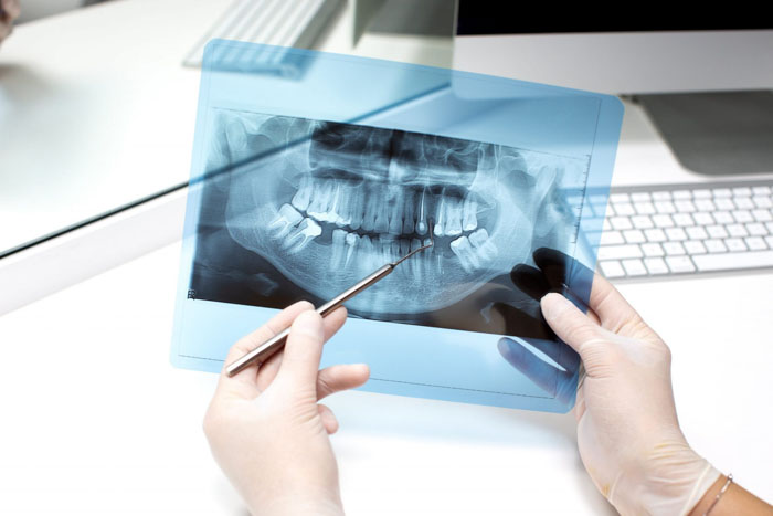 Bác sĩ chỉ định bệnh nhân chụp X-quang răng nhằm đánh giá chính xác tình trạng bệnh