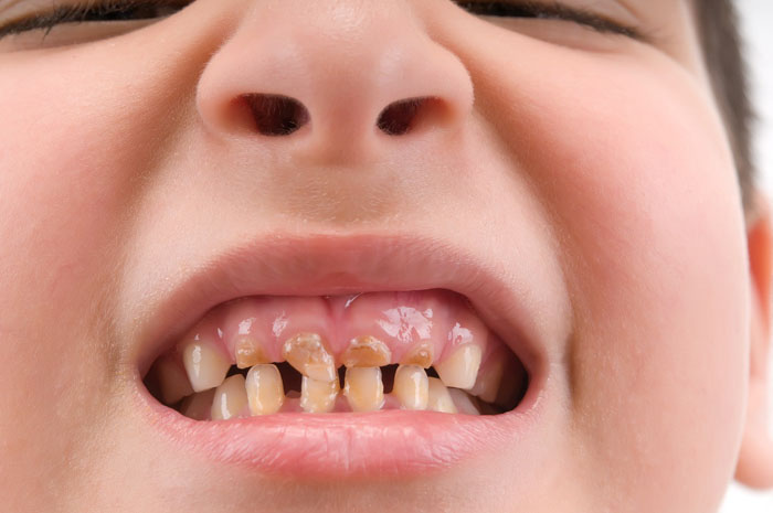Bề mặt răng bị xỉn màu là dấu hiệu của tình trạng mòn răng sữa