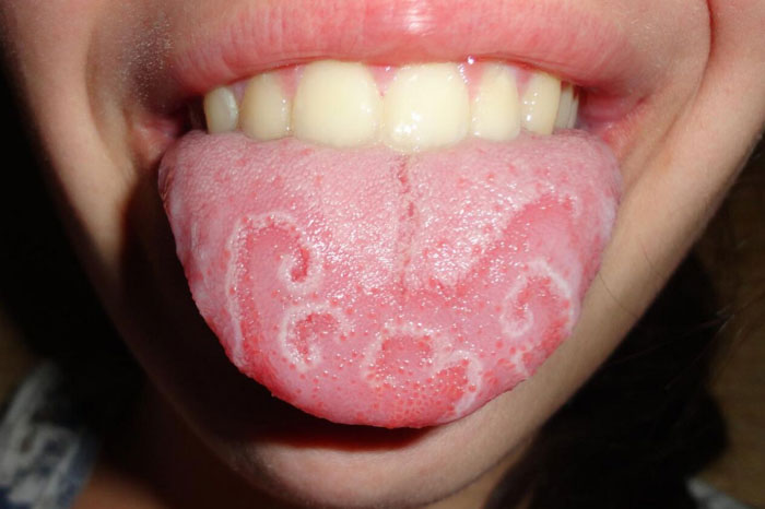 Bệnh lưỡi bản đồ là một dạng rối loạn lành tính không gây ảnh hưởng lớn đến sức khỏe