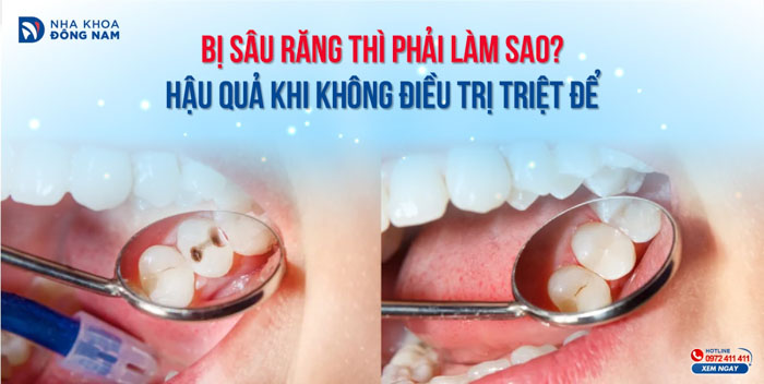 Bị sâu răng thì phải làm sao? Hậu quả khi không điều trị triệt để