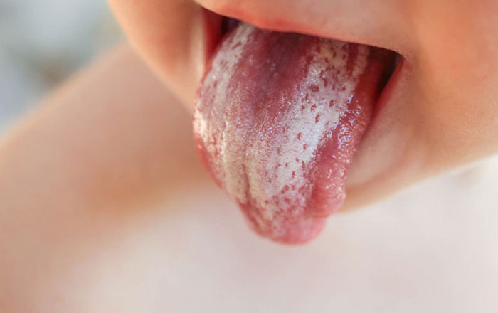 Các đốm trắng, mảng trắng là triệu chứng thường gặp của nấm lưỡi