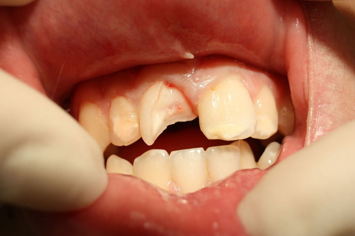 Răng bị gãy mẻ làm tổn thương đến vùng tủy răng