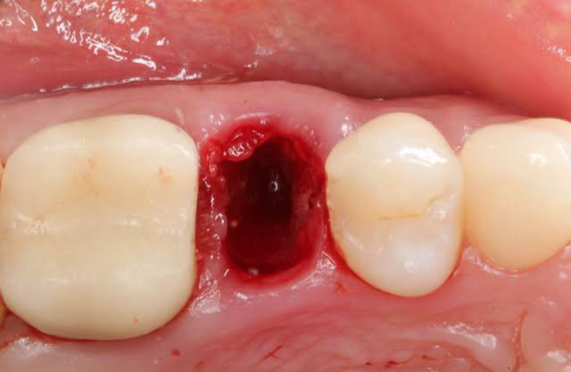 Chảy máu sau nhổ răng là tình trạng hết sức bình thường