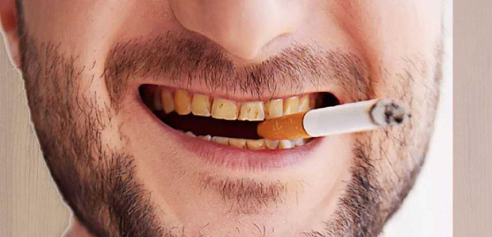 Răng ố vàng, sậm đen do thường xuyên hút thuốc lá