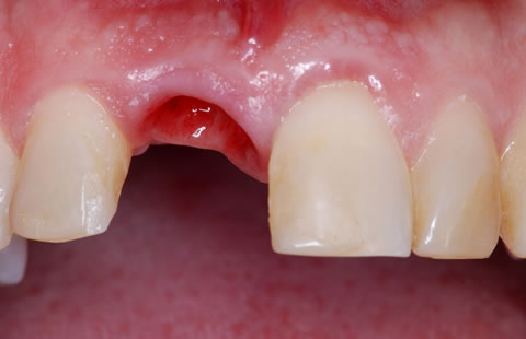 Cục máu đông sau khi nhổ răng