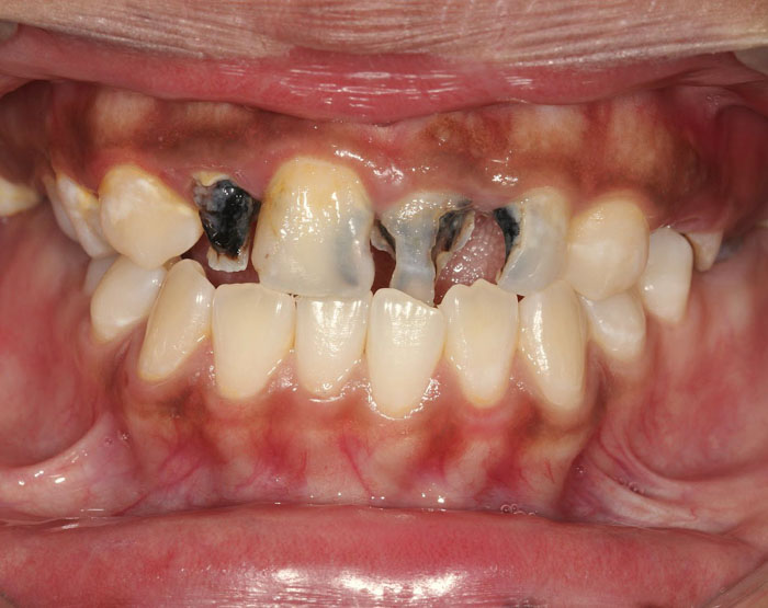 Viêm tủy răng có nguy cơ gây mất răng vô cùng nguy hiểm