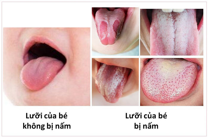 Hình ảnh bệnh nấm lưỡi ở trẻ