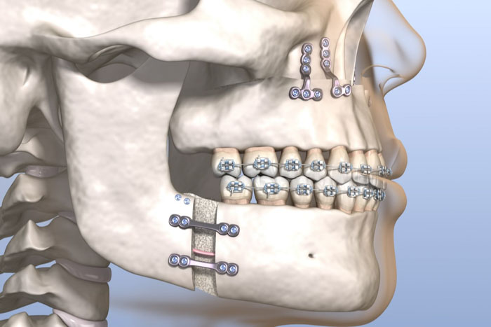 Kết hợp niềng răng và phẫu thuật hàm